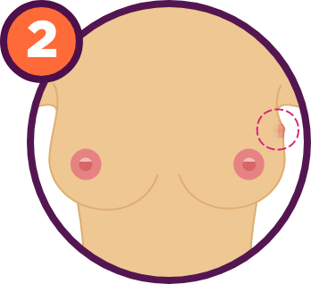 Breast Cancer Signs and Symptoms: A lump in the breast or armpit.