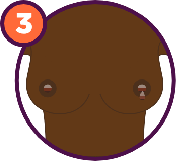 Breast Cancer Signs and Symptoms: A change in the skin around the nipple or nipple discharge.