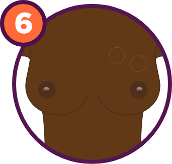 Breast Cancer Signs and Symptoms: An enlargement of the glands.