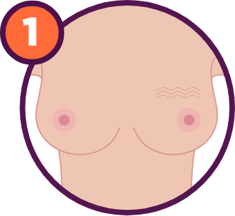 Breast Cancer Signs and Symptoms: A puckering of the skin of the breast.