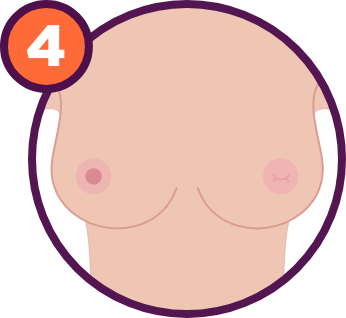 Breast Cancer Signs and Symptoms: Dimpling of the nipple or nipple retraction.
