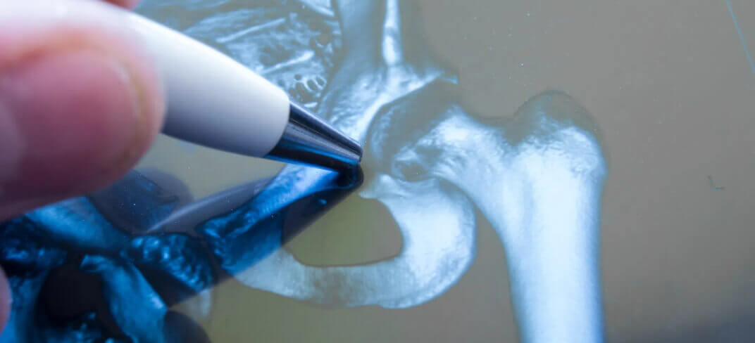 Hip Replacement: Minimally Invasive Anterior Technique. Interview with Dr. Garro. | UPMC Italy