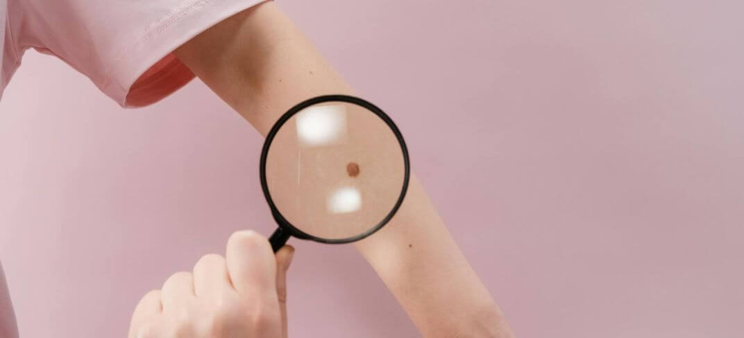 Melanoma: fattori di rischio | UPMC Italy