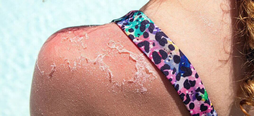 Scottatura o ustione solare? Scopriamo la differenza | UPMC Italy