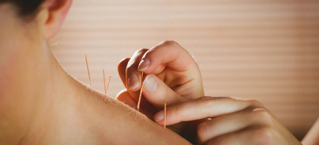 Acupuncture: A Help in Post-Stroke Recovery | UPMC Italy
