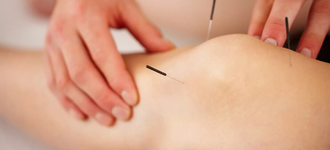 6 Frequently Asked Questions About Acupuncture | UPMC Italy