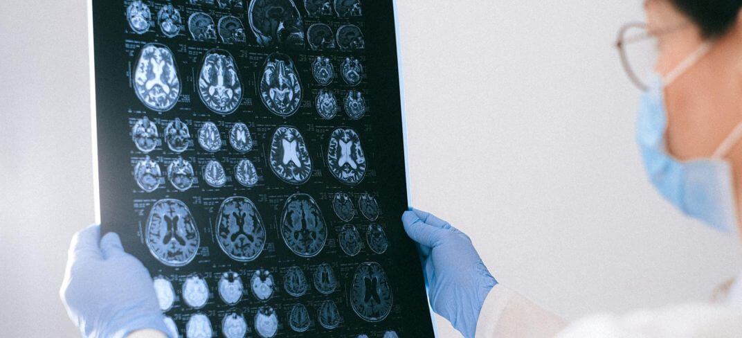 Epilessia: Tutto Quello Che Devi Sapere | UPMC Italy