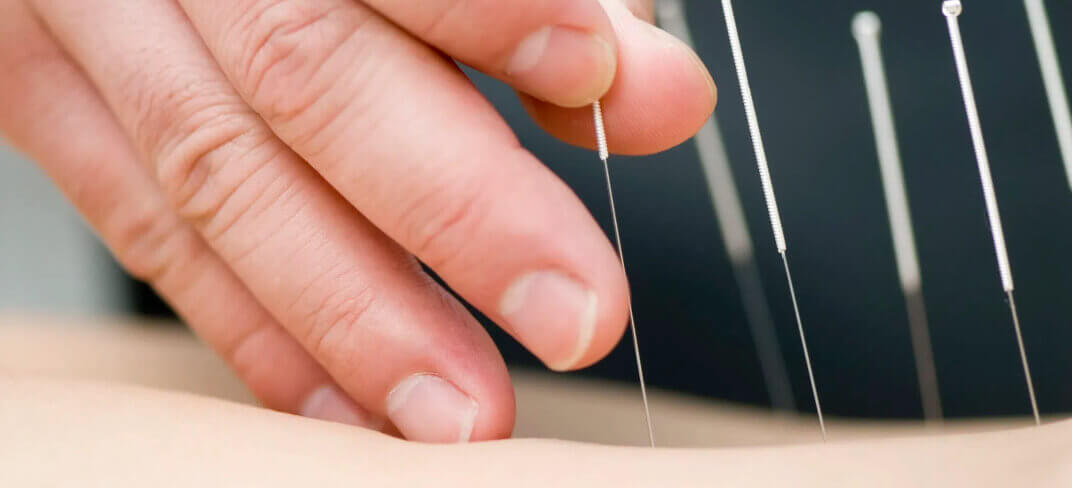 The Benefits of Acupuncture. Interview with Dr. Salvatore Dell'Aquila. | UPMC Italy