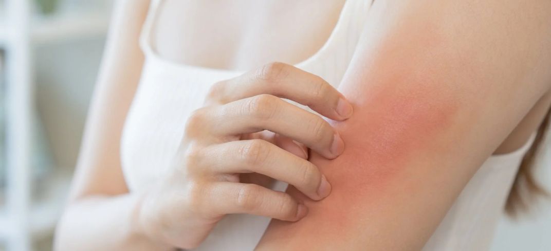 Perché Grattarsi un'Irritazione Cutanea può Peggiorare la Situazione | UPMC Italy