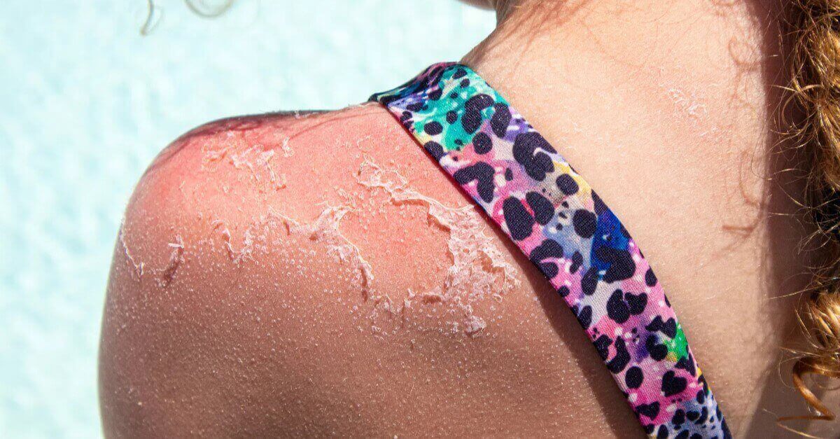 Sunburn or Sun Poisoning? Tell the Difference UPMC Italy